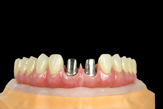 acheter FDA Titane pont implant dentaire cadre de titane avec couronne online manufacture