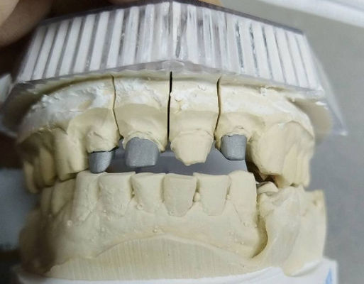 acheter Couronne et pont de métal non précieux post-noyau online manufacture