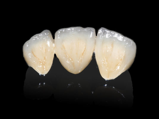 acheter Implantation dentaire PFM pont non précieux CAD CAM PFM couronne online manufacture
