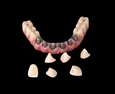 acheter Tout sur X Implantation Titane Pont Dentistique Uniquement Cadre Professionnel online manufacture