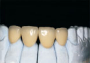 acheter Couronne et pont en alliage précieux de haute noblesse blanche online manufacture