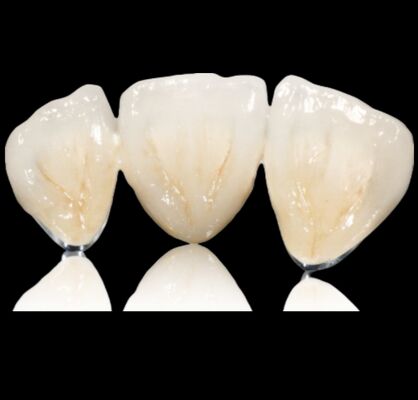 acheter Couronne ou pont semi-précieux personnalisable Couronne et pont en alliage précieux online manufacture