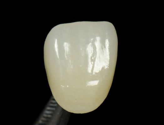 Personnalisable couronne de presse Emax rapide et haute esthétique incrustation dentaire Onlay