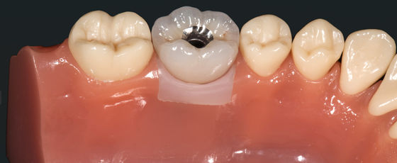Métaux précieux très esthétiques, couronnes implantées, ponts couronnés