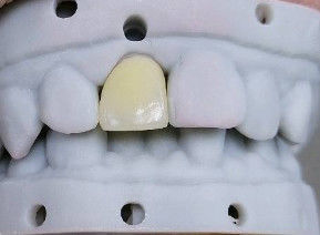 Étoffe de haute esthétique composite couronne onlay placage taille personnalisable