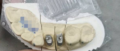 Métallique / Naturel Ti Base Couronne Post Corne Titane couronnes pour les dents