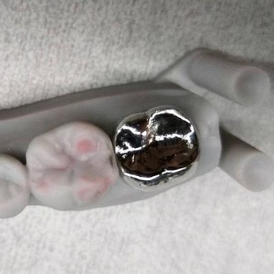 Couronne en métal et pont de haute précision Couronne temporaire en argent