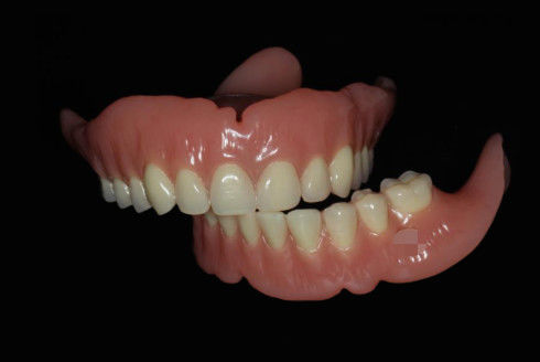 Dentures complètes amovibles numériques Dentures complètes en rose