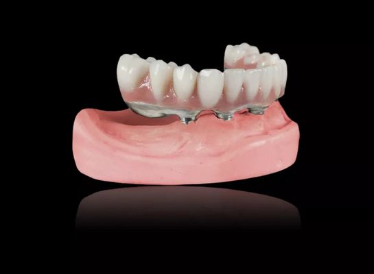 Implantation de barres de titane Prothèses dentaires amovibles Barres de titane en alliage Prothèses en surdent