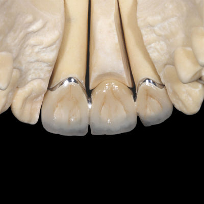 Porcelaine pour implant de couronne PFM non précieuse fondue dans une couronne métallique