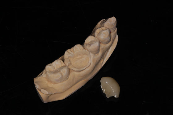 Dental composite Onlay Veneer Haut esthétique Composite Veneer